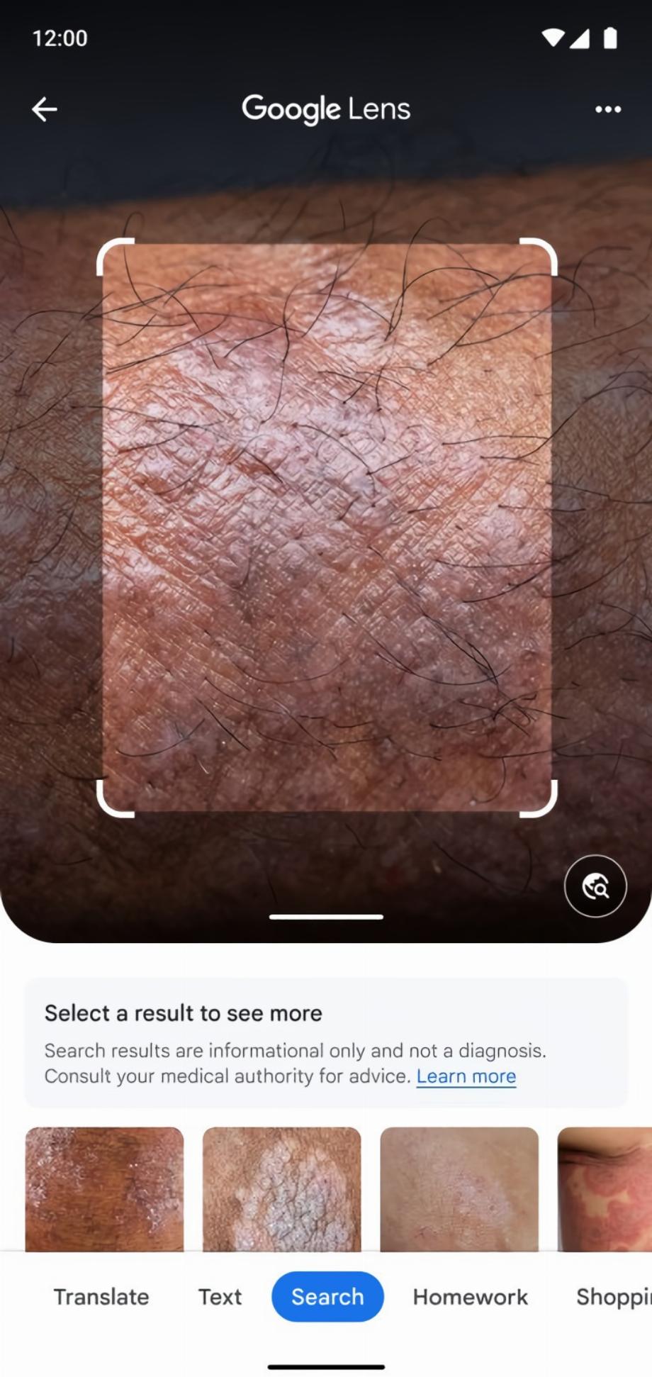 Google Lens utilisera l'intelligence artificielle pour identifier les maladies de la peau. (Google)