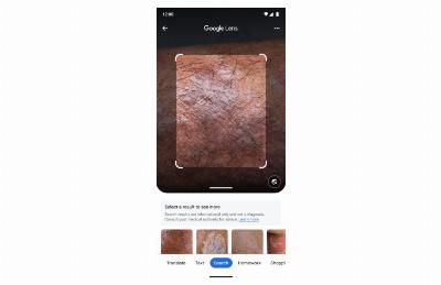 Comment utiliser Google Lens et son intelligence artificielle pour identifier les maladies de la peau