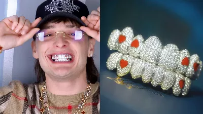 Il voulait imiter des dents en diamant poids plume mais ça tourne mal : « Je ne sais pas comment je vais m'en sortir » | VIDÉO