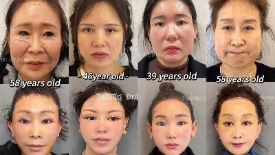 Qui est le Dr Kim, le chirurgien dont le rajeunissement extrême horrifie et captive les utilisateurs de TikTok ?