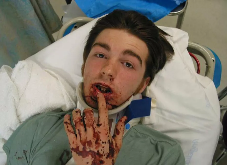 Drake Bell a eu un grave accident en 2005 impliquant une opération au visage. (Photo : @xdrakebellx3/Instagram)
