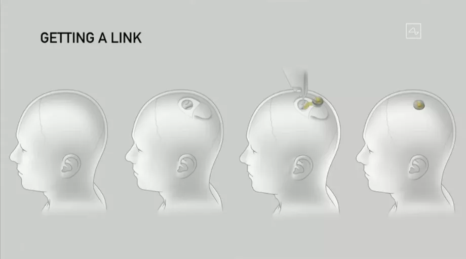 La puce permettra aux utilisateurs de contrôler les appareils avec leurs pensées. (Neuralink)