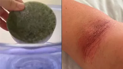 Une femme présente de l'eczéma sur la peau après s'être baignée avec de l'eau contaminée à Benito Juárez | VIDÉO
