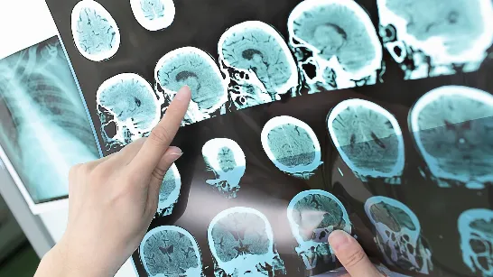 Un groupe de scientifiques espagnols parvient à prédire avec l'IA l'évolution des patients atteints de sclérose en plaques.