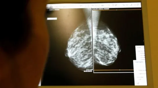 L'IA pourrait détecter des maladies cardiaques chez les femmes grâce aux mammographies