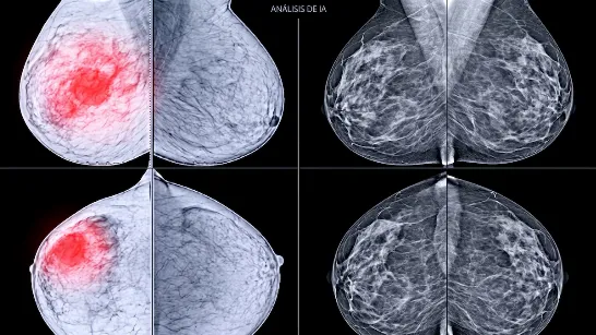Que faire lorsqu'une application de dépistage du cancer du sein provoque de fausses alertes : « Il manque une validation scientifique » Les applications mobiles promettent de détecter le cancer du sein à partir d'images, mais leur fiabilité reste très discutée par les experts médicaux.